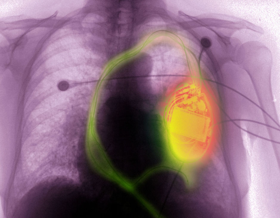 Pacemaker of ingeplante defibrillator en MRI