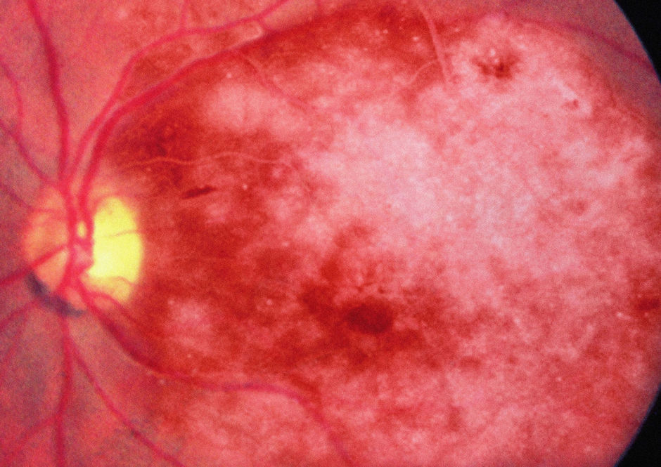 Richtlijnen diabetische retinopathie vernieuwd