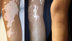 Vitiligo: MKTP-chirurgie is doeltreffend op lange termijn