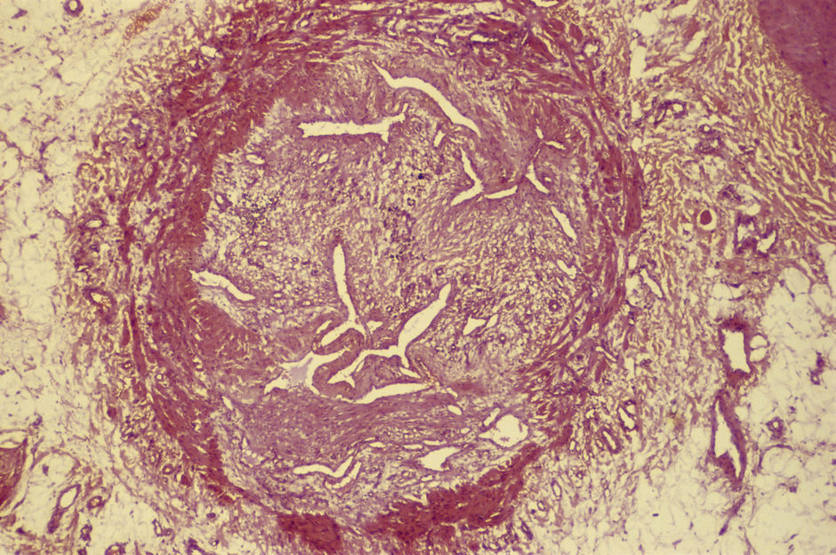 Evolutie van veneuze trombo-embolie volgens kankertype