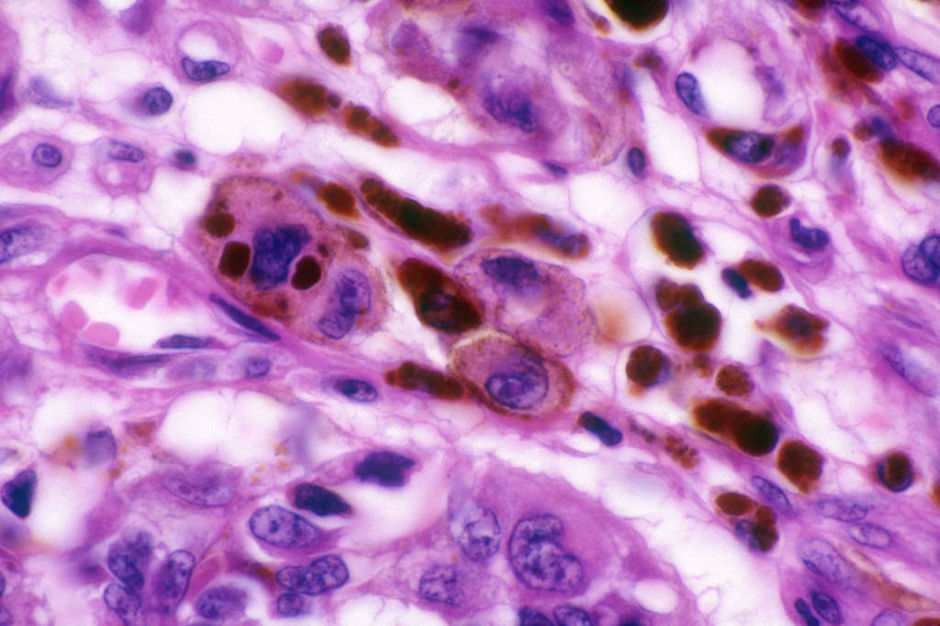 Synergetisch effect immunotherapie en bètablokkers bij gemetastaseerd melanoom