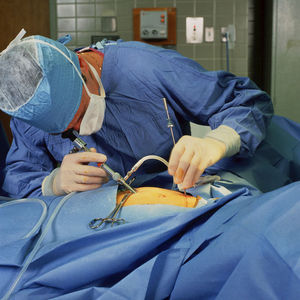 Colonkanker: laparoscopie beter resultaat dan open chirurgie