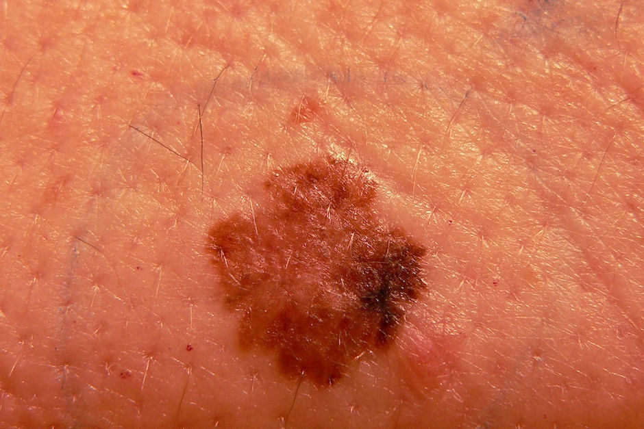 Encorafenib plus binimetinib: nieuwe behandeling bij melanoom