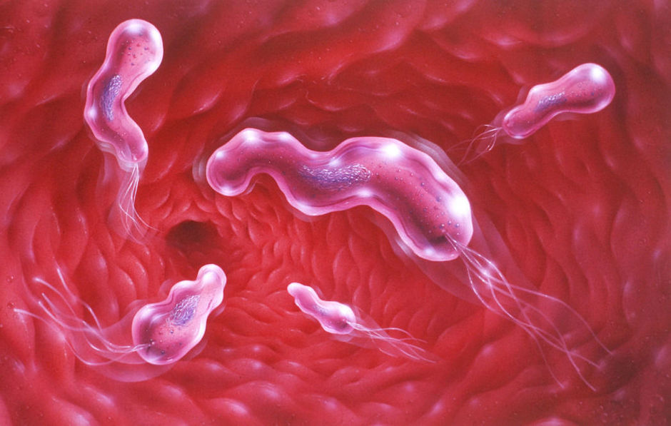 Iatrogene bloeding uit maag- of duodenumulcera: rol van H. pylori