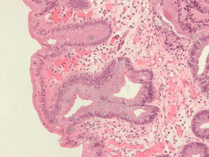 Pathogenese van de Barrett-oesofagus