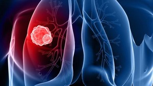 Identificatie van nieuwe subgroepen van longkanker