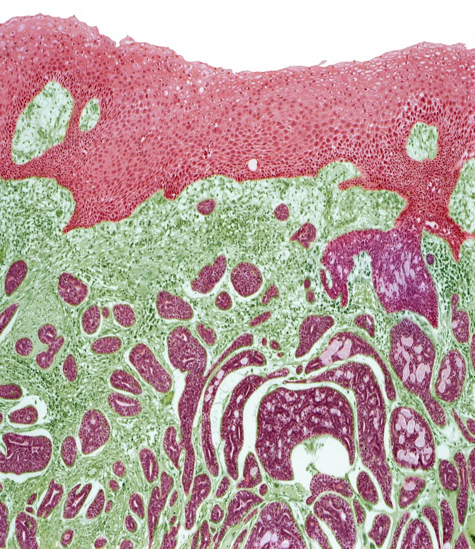 Hoofd- en halskanker: een nieuwe indicatie voor nivolumab?