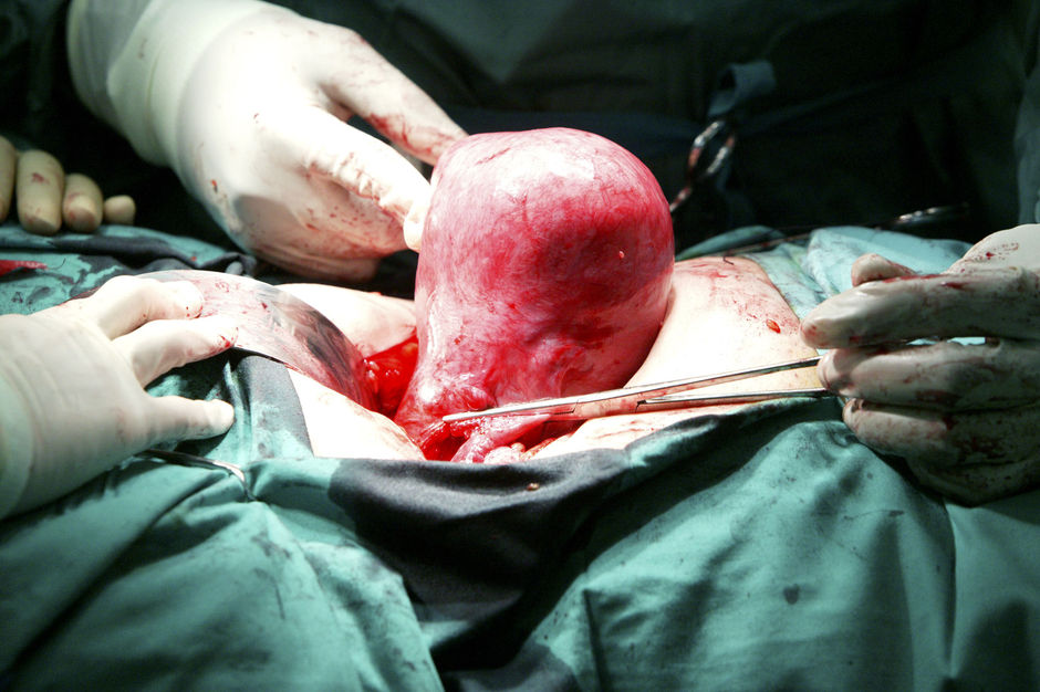 Endometriumkanker: laparoscopische of abdominale hysterectomie?