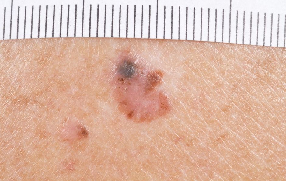 Een nieuwe microscoop die melanomen beter kan detecteren en analyseren