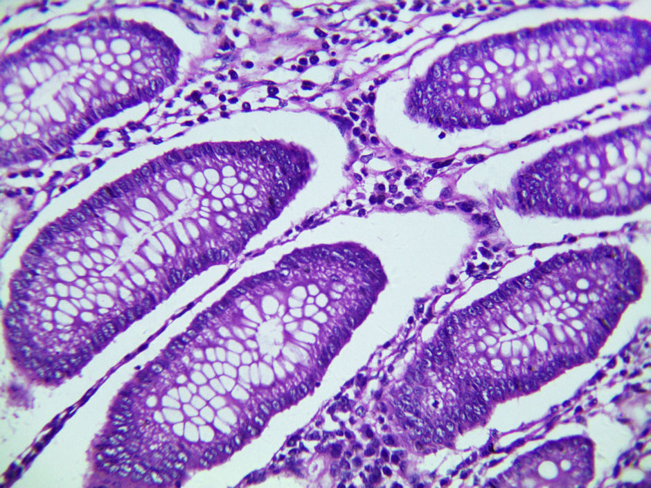 Nomogram om vroege sterfte bij gemetastaseerde colorectale kanker te voorspellen