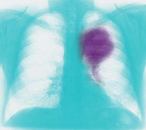 Tweejaarsoverleving met immunotherapie bij gevorderd NSCLC