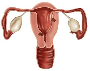 Endometriumcarcinoom: adjuvante chemoradiotherapie niet beter dan radiotherapie