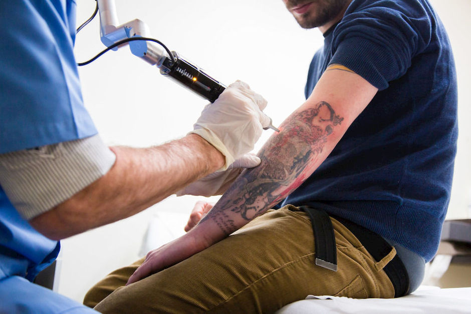 Enkel arts mag tatoeage verwijderen met laser