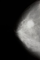 Screeningmammografie bij oudere vrouwen: jaarlijks of om de twee jaar?