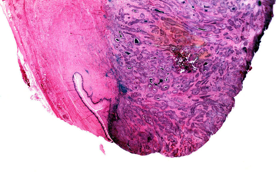 Baarmoederhalskanker: laparotomie beter dan mini-invasieve chirurgie