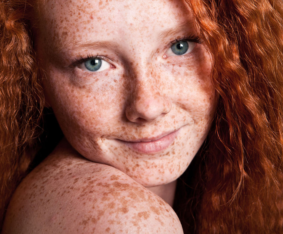 Patiënten met veel schoonheidsvlekken en rood haar lopen een hoger risico op melanoom