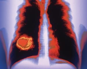 Rokers met BRCA2-mutatie hebben meer kans op longkanker