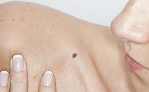Biopsie schildwachtklier ook nuttig bij melanoom van meer dan 4 mm 