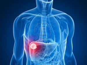 Gevorderd hepatocellulair carcinoom: everolimus doet niets na mislukken van sorafenib