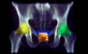Prostaatkanker: rol van adjuvante radiotherapie