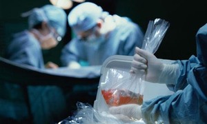 Patiënten met orgaantransplantatie meer vatbaar voor agressief melanoom