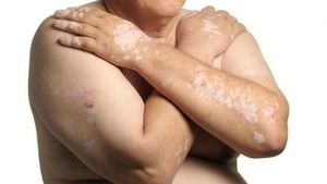 Vitiligo onder behandeling met pembrolizumab: een gunstige prognostische factor?