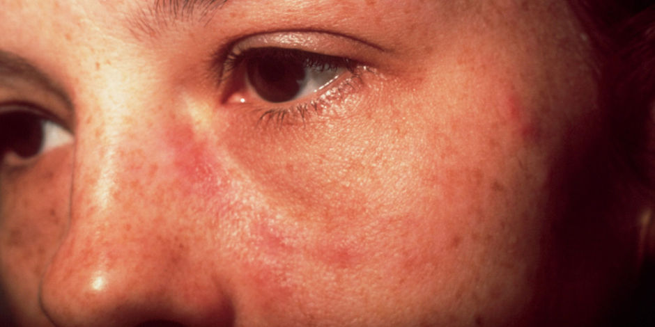 Omega-3 kan mogelijk aanval van lupus afremmen