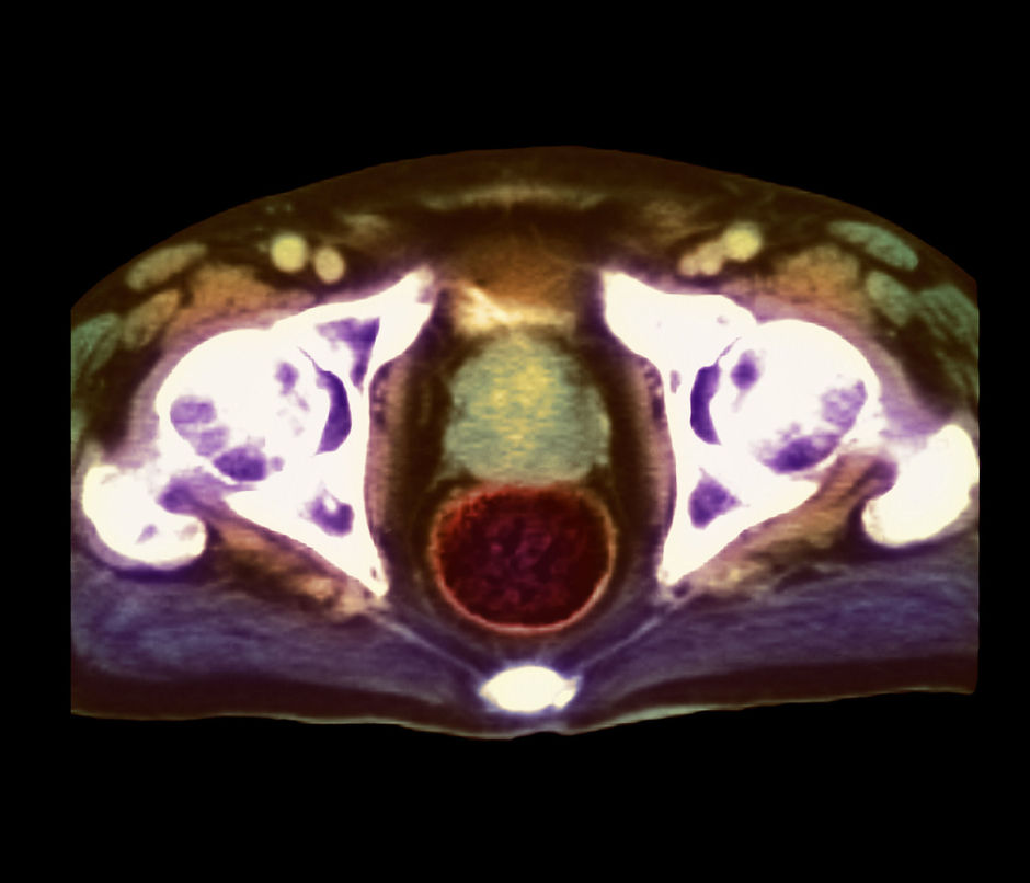 MRI-techniek om prostaatkanker te onderscheiden van normaal weefsel