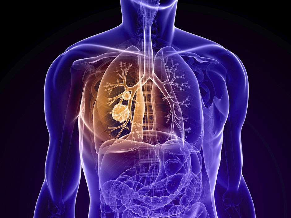Clinical update: COPD, naar een voorspellende geneeskunde op maat
